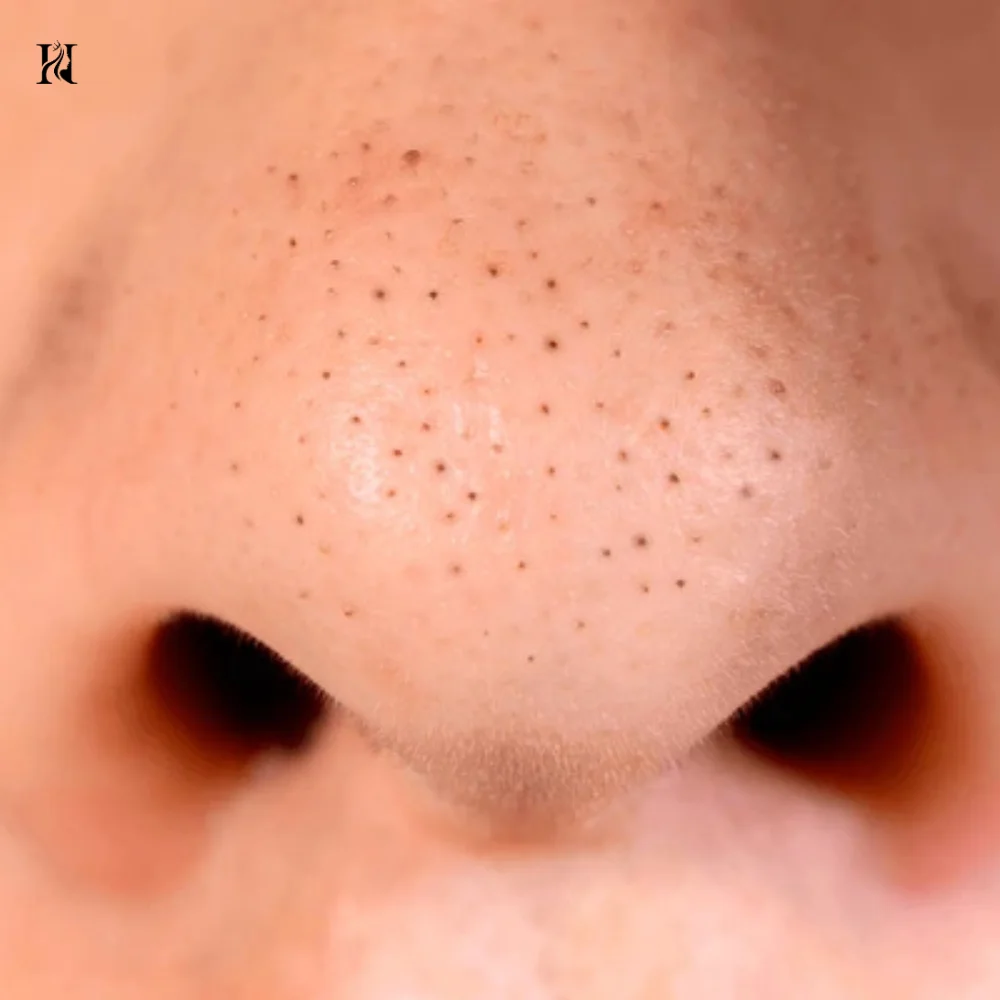 you can see Blackheads on face this picture