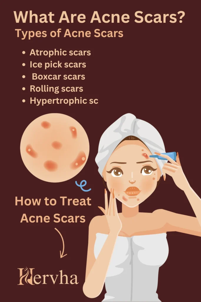 What Are Acne Scars?, Causes, Treatment