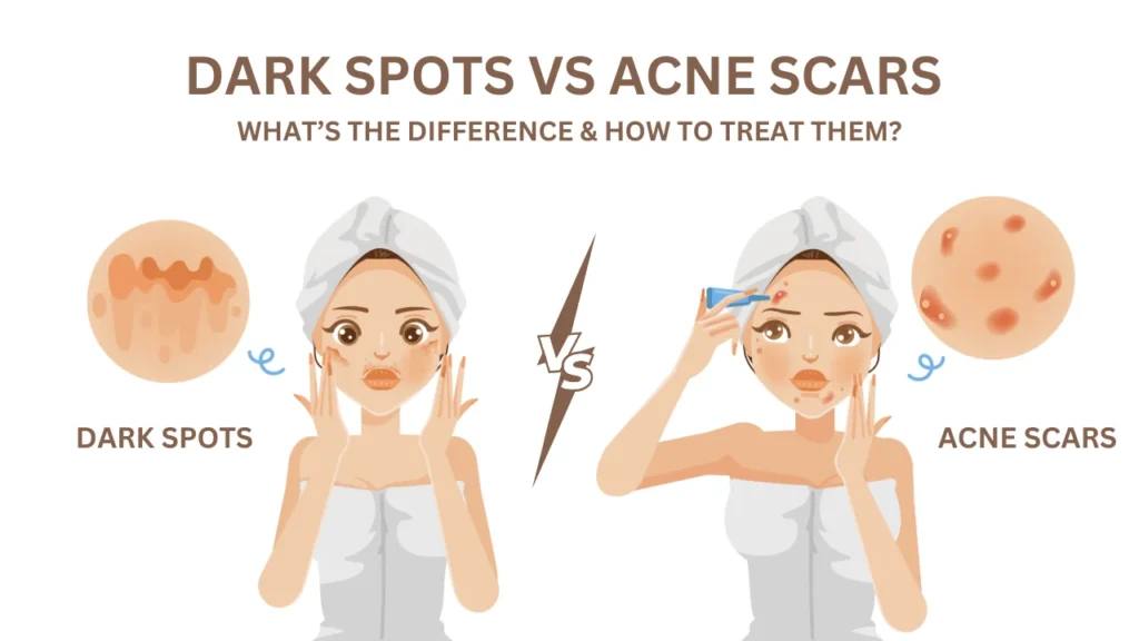 Dark Spots vs. Acne Scars What’s the Difference & How to Treat Them